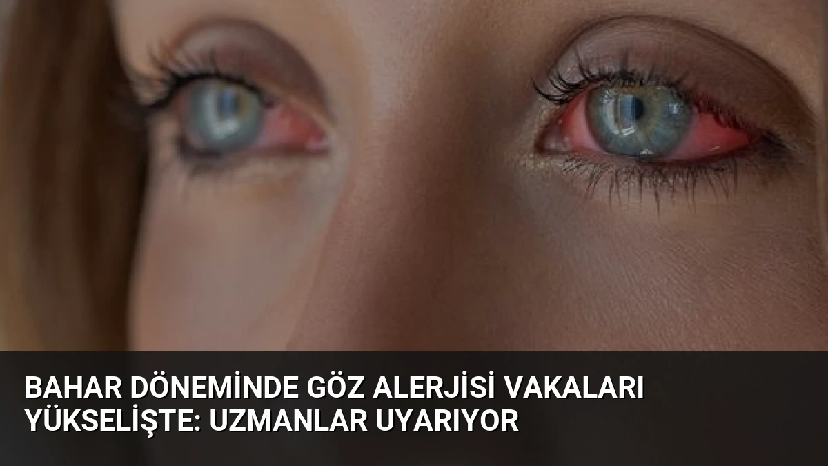 Bahar Döneminde Göz Alerjisi Vakaları Yükselişte: Uzmanlar Uyarıyor