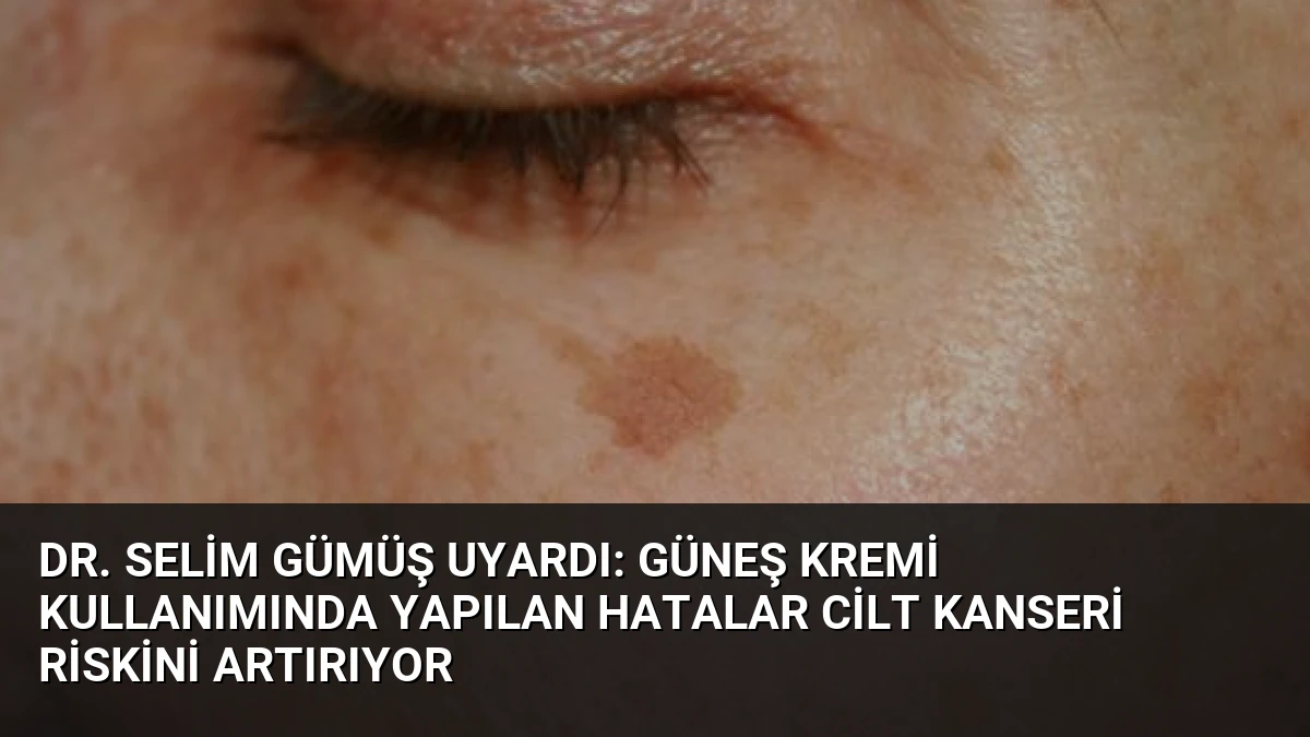 Dr. Selim Gümüş Uyardı: Güneş Kremi Kullanımında Yapılan Hatalar Cilt Kanseri Riskini Artırıyor